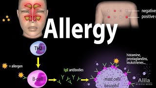 Allergy  Mechanism Symptoms Risk factors Diagnosis Treatment and Prevention Animation [upl. by Einahets]