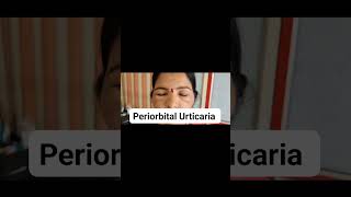 Periorbital Urticaria dermatologist dr Bhutada Skin India [upl. by Jade]