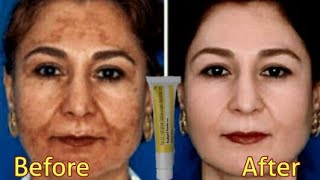 Kojiglo Forte Cream  acne  Pigmentation  Wrinkles  scars skin peeling  BrijwasiGirl [upl. by Lymn142]