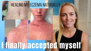 How I Healed My Eczema Naturally  My Story with Eczema  Naturopathic Doctor [upl. by Ocnarfnaig]