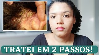 NUNCA MAIS TIVE DERMATITE DEPOIS DESSES CUIDADOS [upl. by Lasonde]