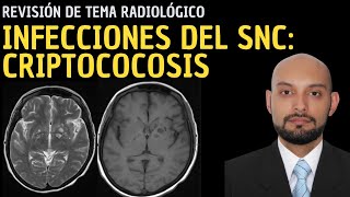 Radiología en 5 minutos Infecciones del sistema nervioso central Criptococosis [upl. by Akirdnahs838]