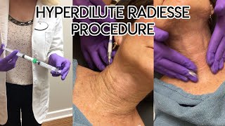 Hyperdilute Radiesse Procedure [upl. by Annmarie890]