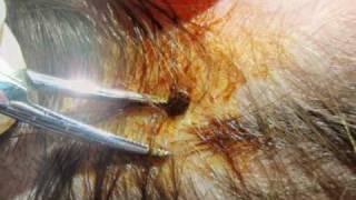 How To Remove a Tick in the ER [upl. by Innis]