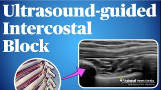 Rectus Sheath Block [upl. by Ssur]