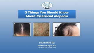 Cicatricial Alopecia 3 things you should know with Jennifer Krejci MD [upl. by Groh]