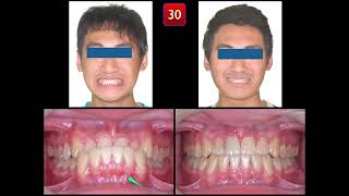 Solving Class III Malocclusion with Anterior Crossbite｜【Chris Chang Ortho】CC723 [upl. by Ijat]