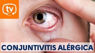 Claves sobre la conjuntivitis alérgica [upl. by Herzel948]