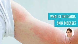 What Is Urticaria Hives Skin Disease Causes Symptoms amp Diagnosis [upl. by Christine561]