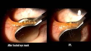 Meibomian Gland Expression Upper and Lower Lid [upl. by Ebsen]