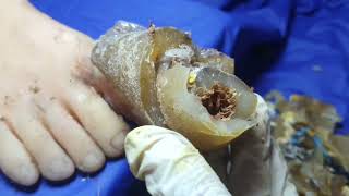 TREATMENT OF Toenails Cut toenails with severe fungus left untreated for a long time  New Cut89 [upl. by Avigdor]