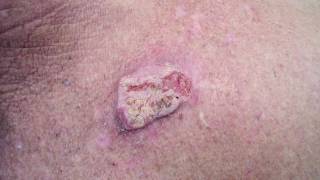 How dangerous is Squamous Cell Carcinoma [upl. by Rehtul]