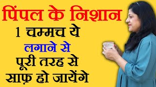 पिम्पल के दाग कैसे हटाये How To Remove Pimple Marks by Sonia Goyal  pimple ke daag hatane ke upay [upl. by Isabel]