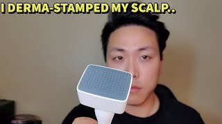 I USED A DERMA STAMP FOR HAIR GROWTH AND THIS IS WHAT I THOUGHT OF IT [upl. by Aynek]