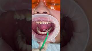 Porcelain veneers procedure  dental veneers procedure step by step  smile makeover  Dr Yazdan [upl. by Sanfourd]