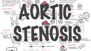 Aortic Stenosis  Overview signs and symptoms pathophysiology treatment [upl. by Uolymme]