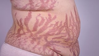 Does Liposuction Reduce Stretch Marks Liposuction Specialist Trevor Schmidt PAC MyShape Lipo [upl. by Belcher]