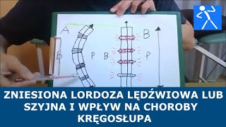 Spłycona zniesiona lordoza lędźwiowa  Przyczyna chorób kręgosłupa  Ćwiczenia  🇵🇱 🇪🇺 [upl. by Durgy]