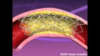 Heartistry Stent Implant Animation [upl. by Isoj]