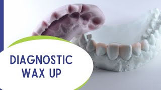 Diagnostic Wax up [upl. by Flossi]