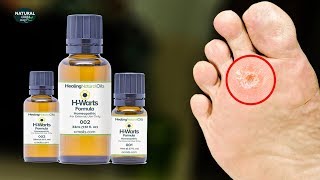 How To Get Rid Of Warts Fast with Healing Natural Oils HWarts Formula [upl. by Yma]