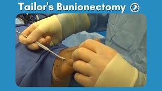 Tailors Bunionectomy performed by Dr Paul Steinke [upl. by Harad]