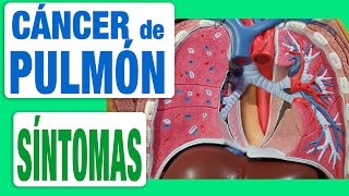 Cáncer de Pulmón  Síntomas [upl. by Ahsinad]