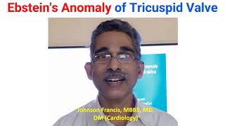 Ebsteins Anomaly of Tricuspid Valve [upl. by Jaquith]