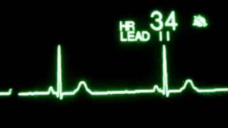 Sinus Bradycardia [upl. by Pacorro]