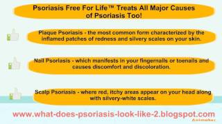 What does psoriasis look like  Psoriasis free for life review [upl. by Lebna]