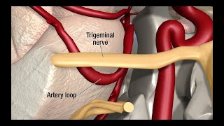 Treatment for Trigeminal Neuralgia UCSF Neurosurgery [upl. by Allbee]