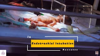 Endotracheal Intubation in neonates [upl. by Etteiluj]