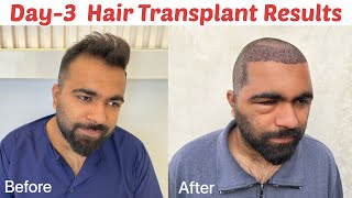 My Hair Transplant Results after 3 Days  Swelling after Hair Transplant  How to clean Donor area [upl. by Niveg]