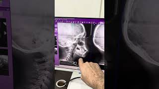 Jaw correction and connection with body posture balance [upl. by Durman]