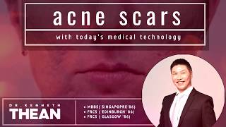 Treatment of Acne Scars  Dr Kenneth Thean [upl. by Heintz]