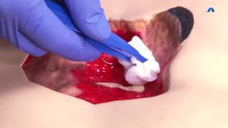 How to Effectively Cleanse and Debride a Wound  Wound Cleansing and Debridement  Ausmed Education [upl. by Conway]