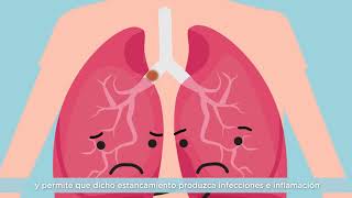 Vídeo 1  ¿Qué es la Fibrosis Quística [upl. by Erick402]