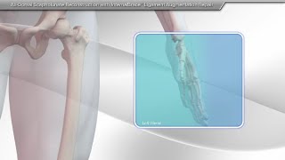 AllDorsal Scapholunate Reconstruction With InternalBrace™ Ligament Augmentation Repair [upl. by Whitson8]