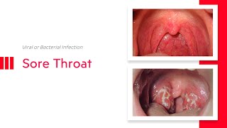 Sore Throat Viral or Bacterial Infection [upl. by Hultgren]