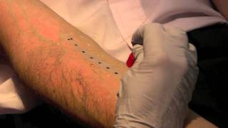 Skin Prick Allergy Test [upl. by Notserc]