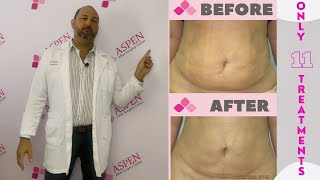 Liposuction Fibrosis Treatment Soften and Smooth Lumps and Bumps [upl. by Aynotan]