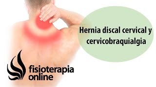 Hernia discal cervical y cérvicobraquialgia [upl. by Eiliab]