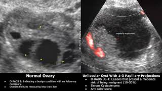 OvarianAdnexal Reporting and Data System Ultrasound ORADS US  Classification Of Ovarian Lesions [upl. by Koralie]