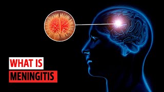 What is Meningitis [upl. by Letizia]