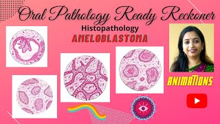 Ameloblastoma Odontogenic TumorsI Follicular PlexiformAcanthomatous Granular [upl. by Afatsom]