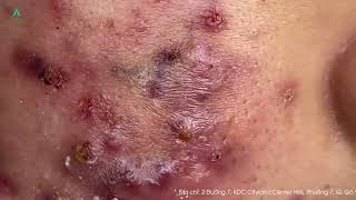 Big Cystic Acne Blackheads Extraction Blackheads amp Milia Whiteheads Removal Pimple Popping [upl. by Hillyer]