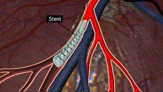 Whats a stent [upl. by Deonne370]