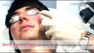 AKNE LIVEBEHANDLUNG  Isolaz und Fraxel Laser  DERMA LOFT Gladbeck [upl. by Mairim]