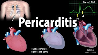 Pericarditis Symptoms Pathophysiology Causes Diagnosis and Treatments Animation [upl. by Nesaj]