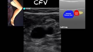 POCUS  Lower Extremity Deep Venous Thrombosis DVT  Updated [upl. by Allayne831]